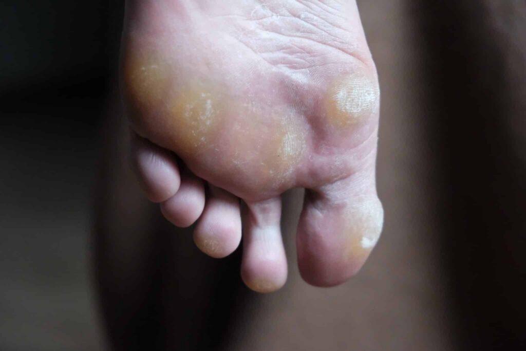 How To Remove Calluses From Your Feet | Doncaster Foot Clinic