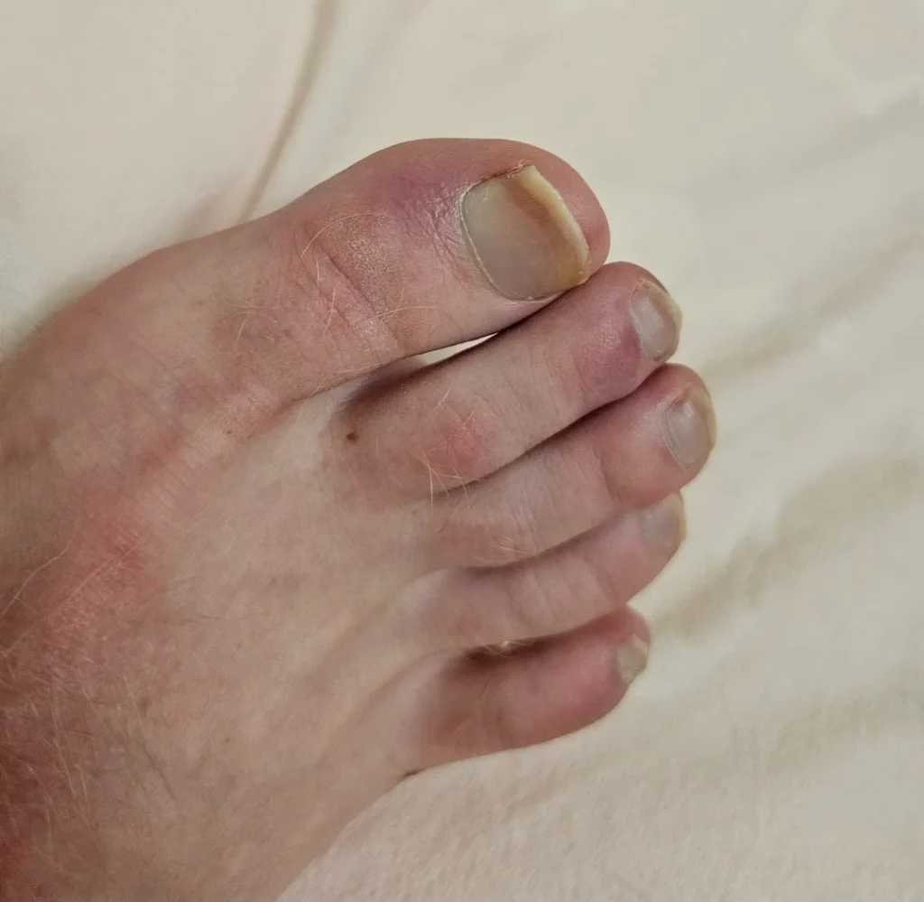 Chilblains A