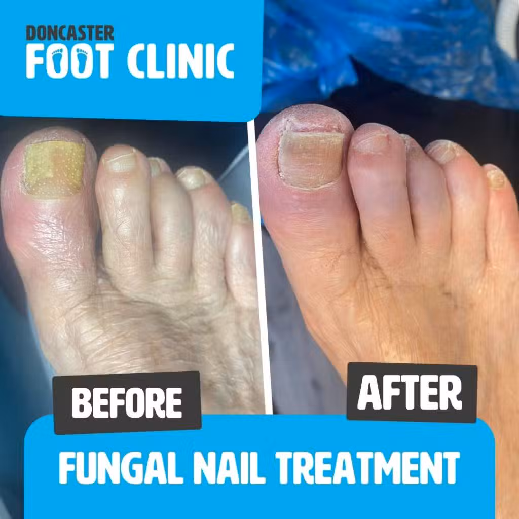 clearanail fungal treatment before after