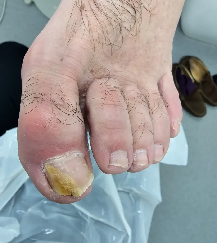 fungal nail D e1776156874103